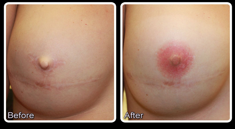 Areola Correction with Permanent Makeup