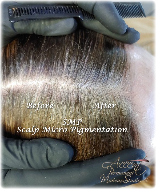 Scalp MicroPigmentation - Accent Permanent Makeup