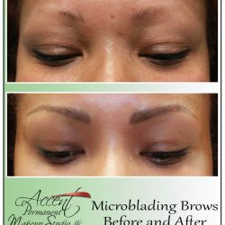 CLIENT OVER-TWEEZED; BROW HAIR RESTORED WITH PERMANENT MAKEUP