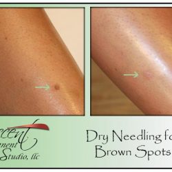BROWN SPOTS CAN ALSO BENEFIT FROM MCA